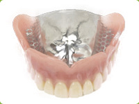 自費診療の入れ歯