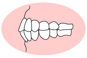 上下顎前突（じょうげがくぜんとつ）